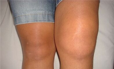 The causes of osteoarthritis of the knee joint