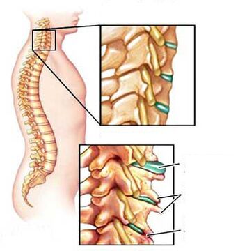 Comparison of a healthy and sick vertebrae in the neck